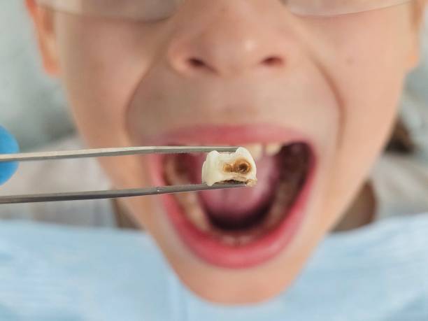 Best Emergency Dentist for Lost Fillings or Crowns in Fairview, UT